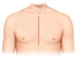 通常の胸骨正中切開(25~30 cm切開)