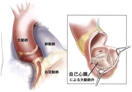 a)自己心膜を使用した大動脈弁再建術